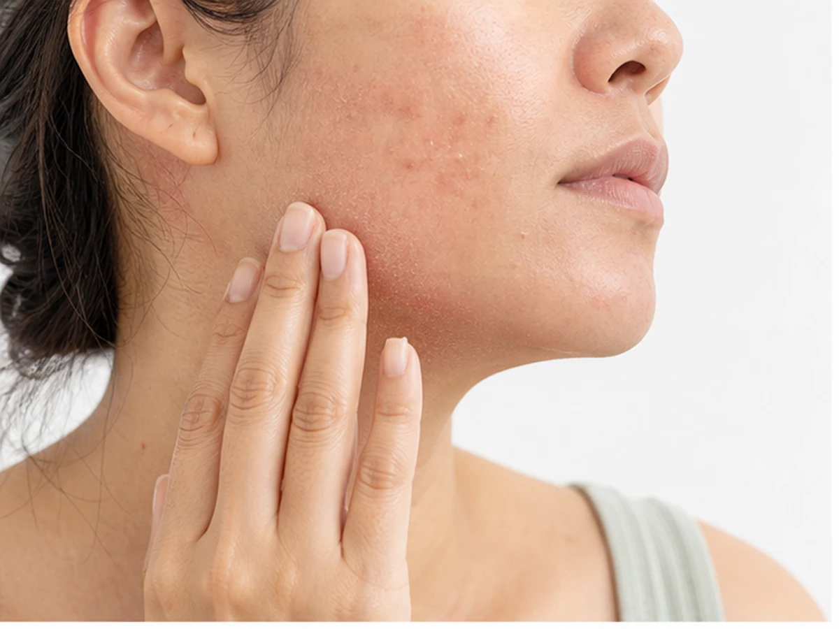 Eczema flare-up with resulting hyperpigmentation on skin