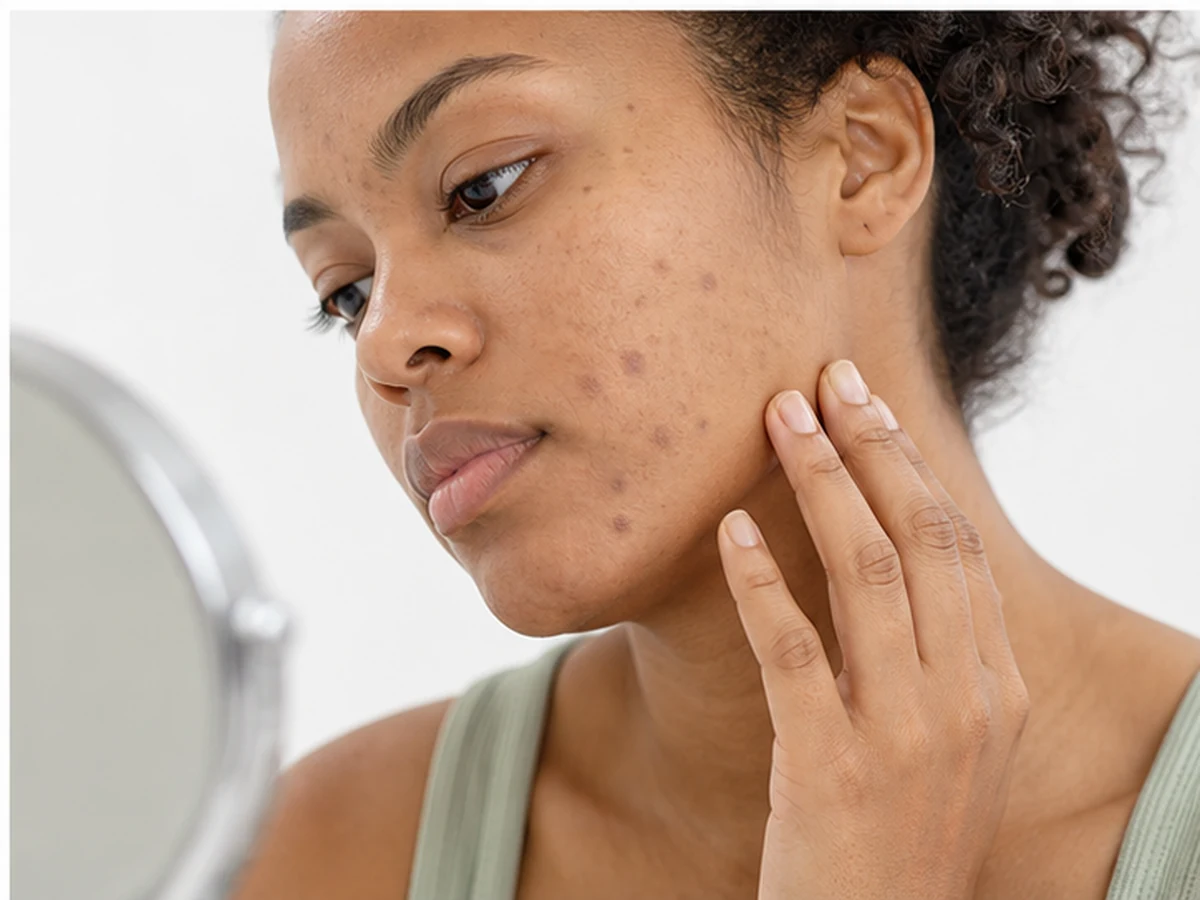 Hyperpigmentation spots appearing in multiple areas of skin