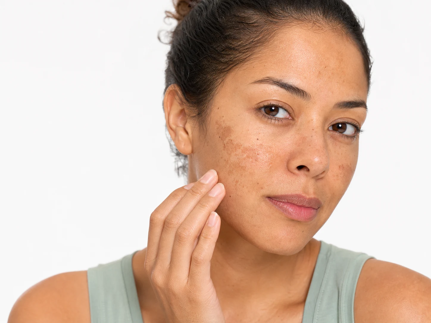 Vitamin C serum with skin showing improvement in hyperpigmentation
